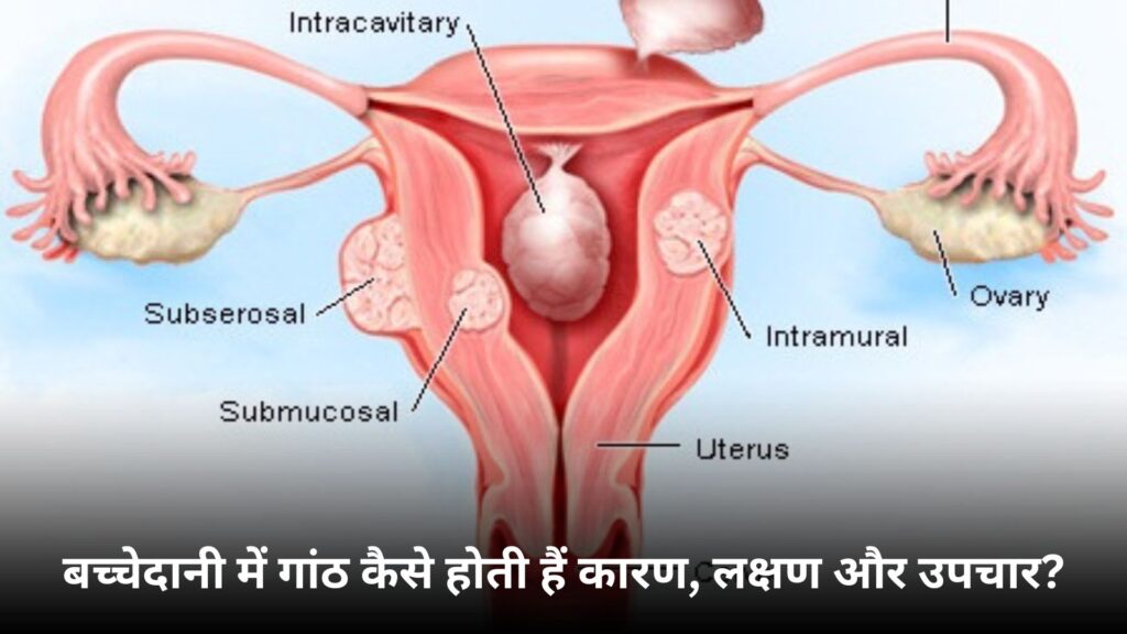 बच्चेदानी में गांठ कैसे होती हैं कारण, लक्षण और उपचार : Uterus Me Ganth Kaise Hota Hai
